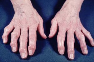 Artrosi Mani Cure Naturali, Rimedi, Cause e Conseguenze della malattia
